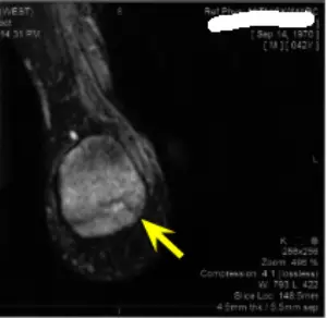 mri heel fracture