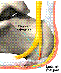 heel neuroma