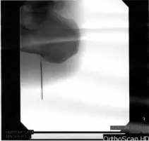 heel spur surgery under fluoroscopy