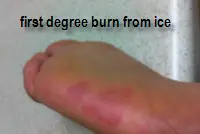 burns foot ice burn degree look