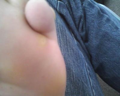 wart under baby toe