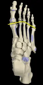 metatarsal_parabola