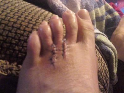 2 weeks after surgery to remove both neuromas