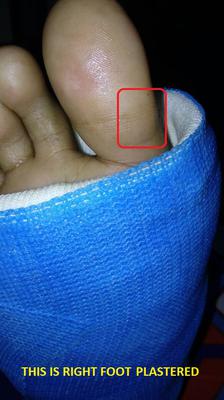 localized nerve entrapment