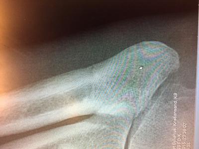 Jones fracture?