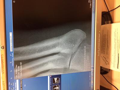 Possible stress fracture