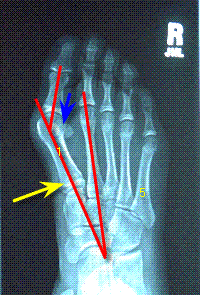 x-ray of juvenile bunion