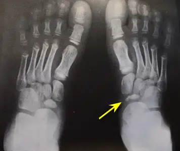 kohlers disease xray