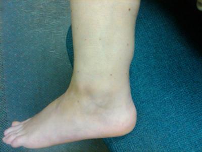 outer left ankle