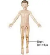 short left leg