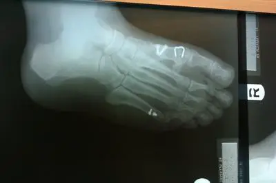 bunion osteotomy