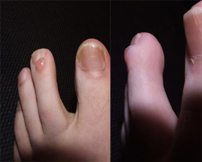 Lump on my toe