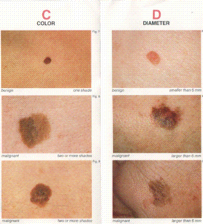 various signs of melanoma