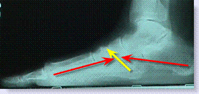 midtarsal fault xray