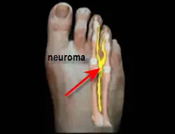 view of Morton's neuroma