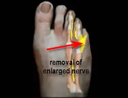 excision of morton's neuroma