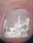 fungus toe nail