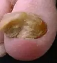 onychomycosis