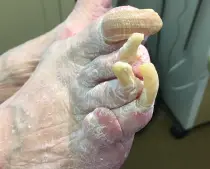 severe_nail_fungus