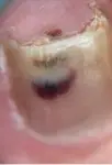 melanoma of nail