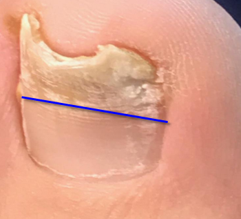 lasered toe nail