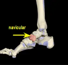 Symptoms Cracked Bone In Foot