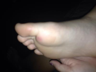 swelling in foot from foreign body