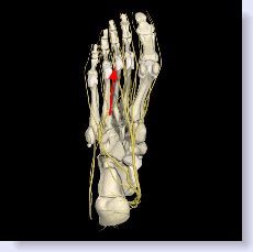 skeletal view of Mortons neuroma