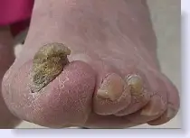 severe_nail_fungus
