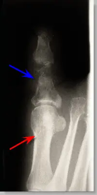 osteomyelitis of great toe