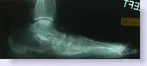 osteoporosis foot x-ray