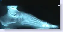 normal foot x-ray