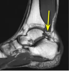 ostrigonum_mri