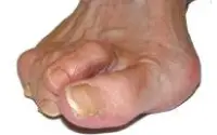 overlapping_toes