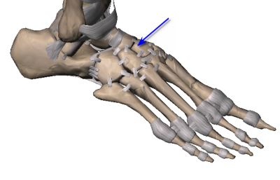 midtarsal fault