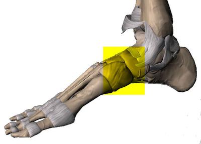 midtarsal fault