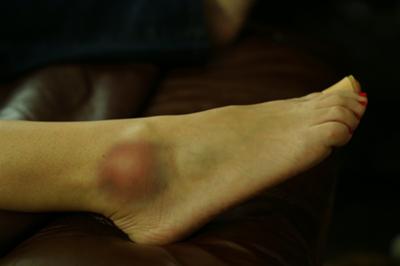 Pain, Swelling and bruising in ankle w/bottom & behind heel pain.Over 2