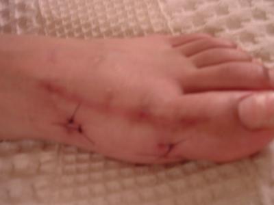 Left Foot (still with sutures from third surgery to remove screws from previous bunionectomies)