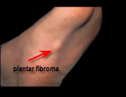 plantar fibroma foot