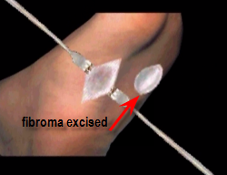 fibroma excised