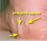 piezogenic papules in foot