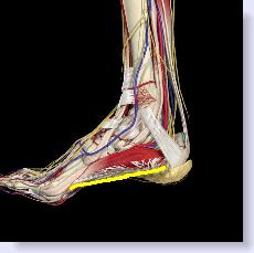 plantar fasciitis