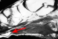 mri_plantarfibromatosis