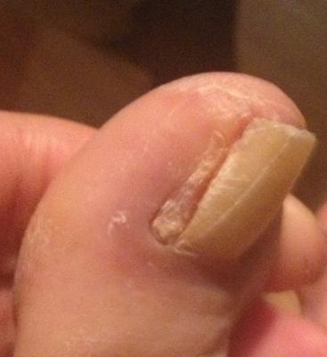 four months post ingrown nail surgery