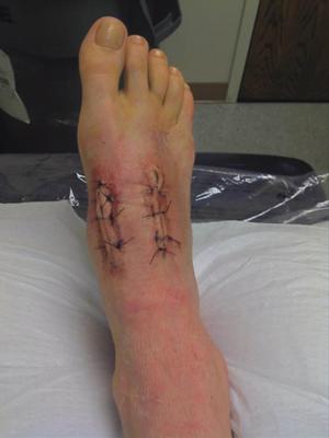 2 weeks post-op-Lisfranc surgery