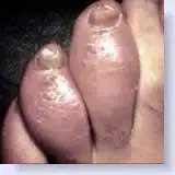 sausage toes seen in psoriasis