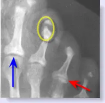 foot x-ray of psoriasis