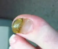 nail_fungus-improved