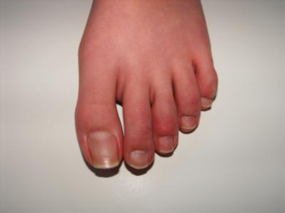 Purple Toes Left Foot