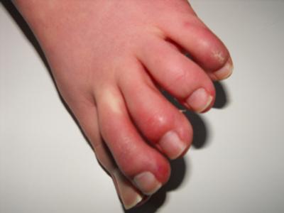 Toes Showing Tightness & Red Blotches